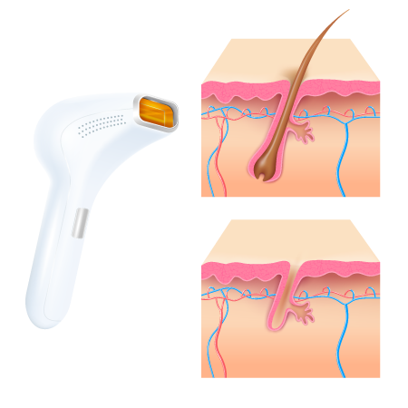 depilacion laser hombre