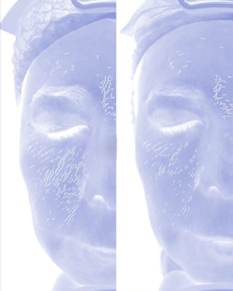 Sculptra Bogota