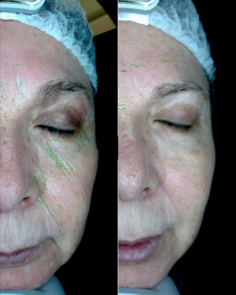 Sculptra Bogota